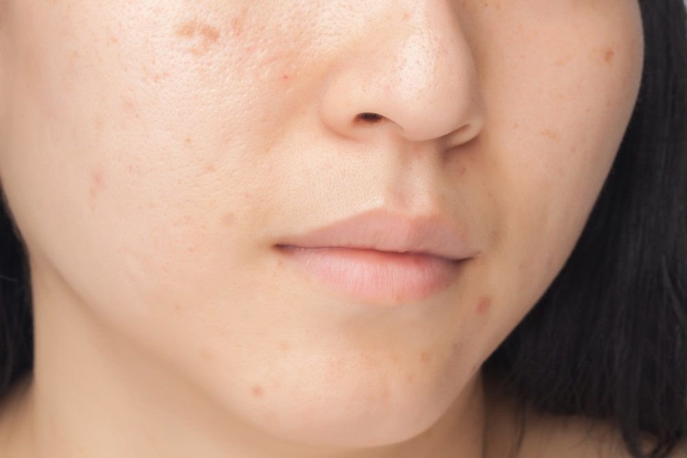 Connecticut Laser Treatment for Acne Scars