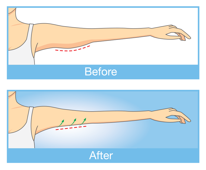 Before and after arm lift illustrations