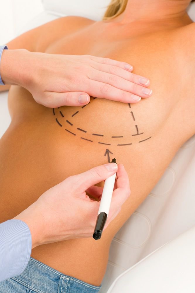 Incision marks for breast reduction surgery