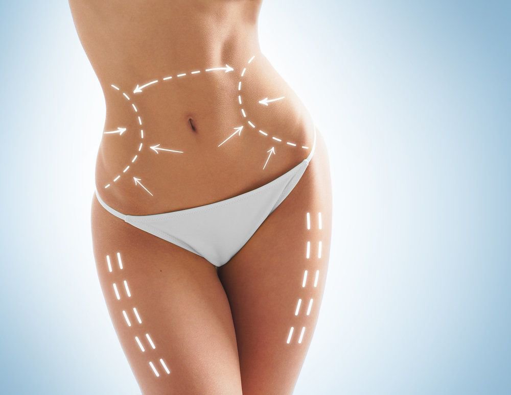 Fairfield County liposuction model