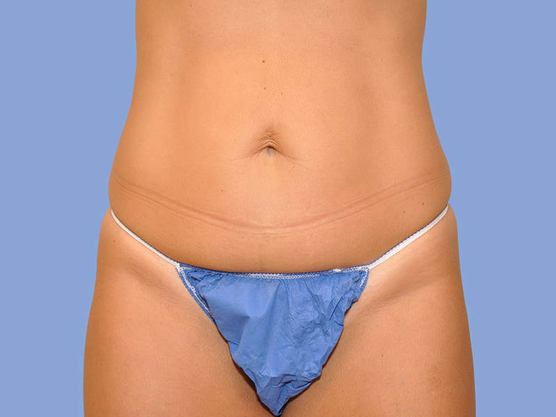 Abdominoplasty before & after photo