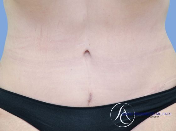 Post bariatric surgery before & after photo