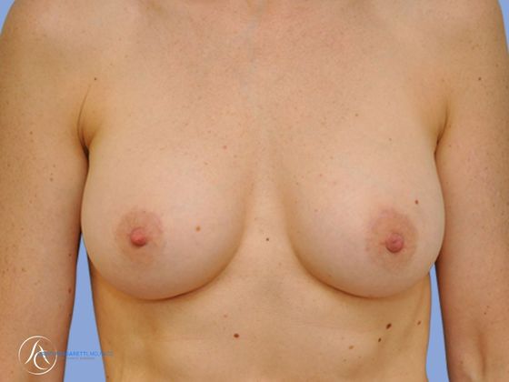 Breast implant revision before & after photo