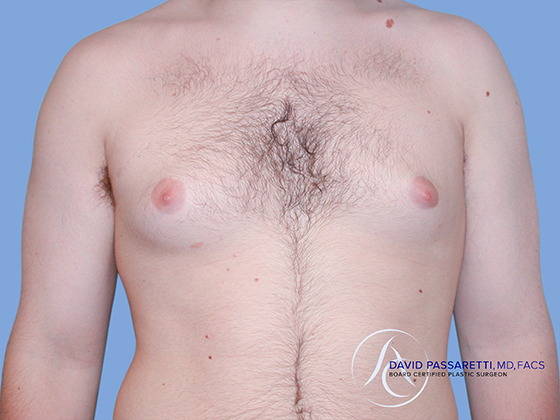 Male breast reduction before & after photo