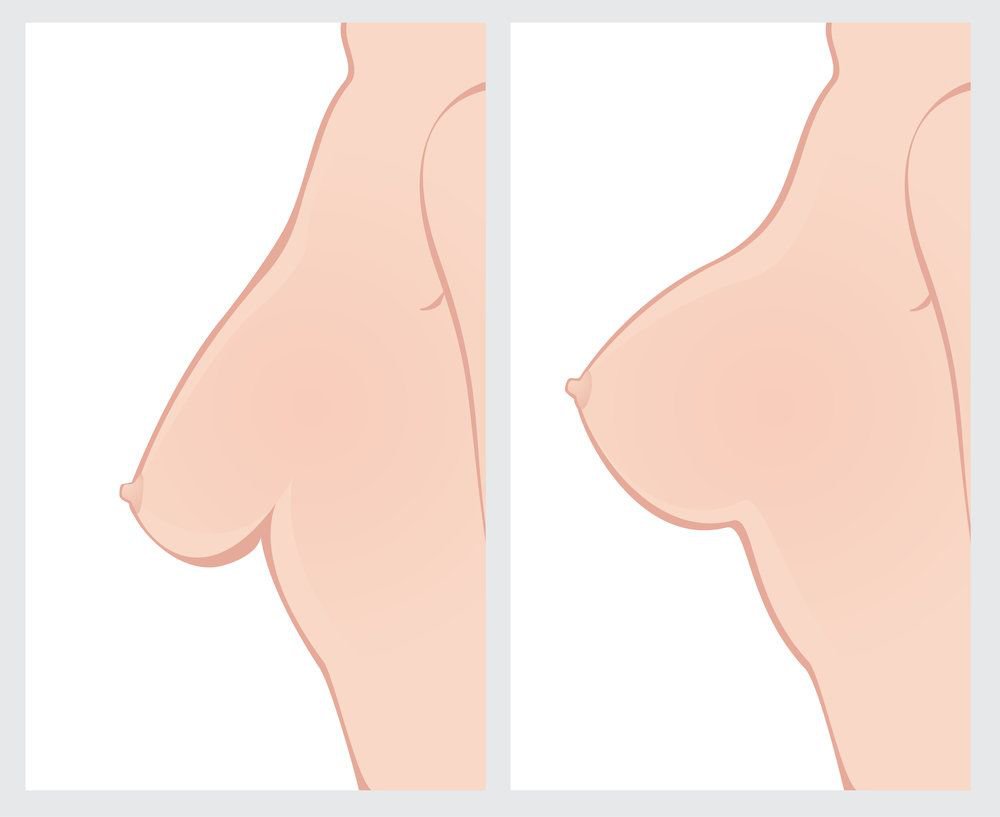 Before and after breast lift surgery