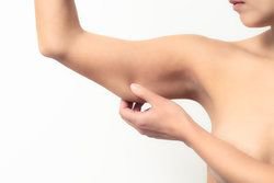 Woman pinching flabby, excessive skin hanging from her lower arm