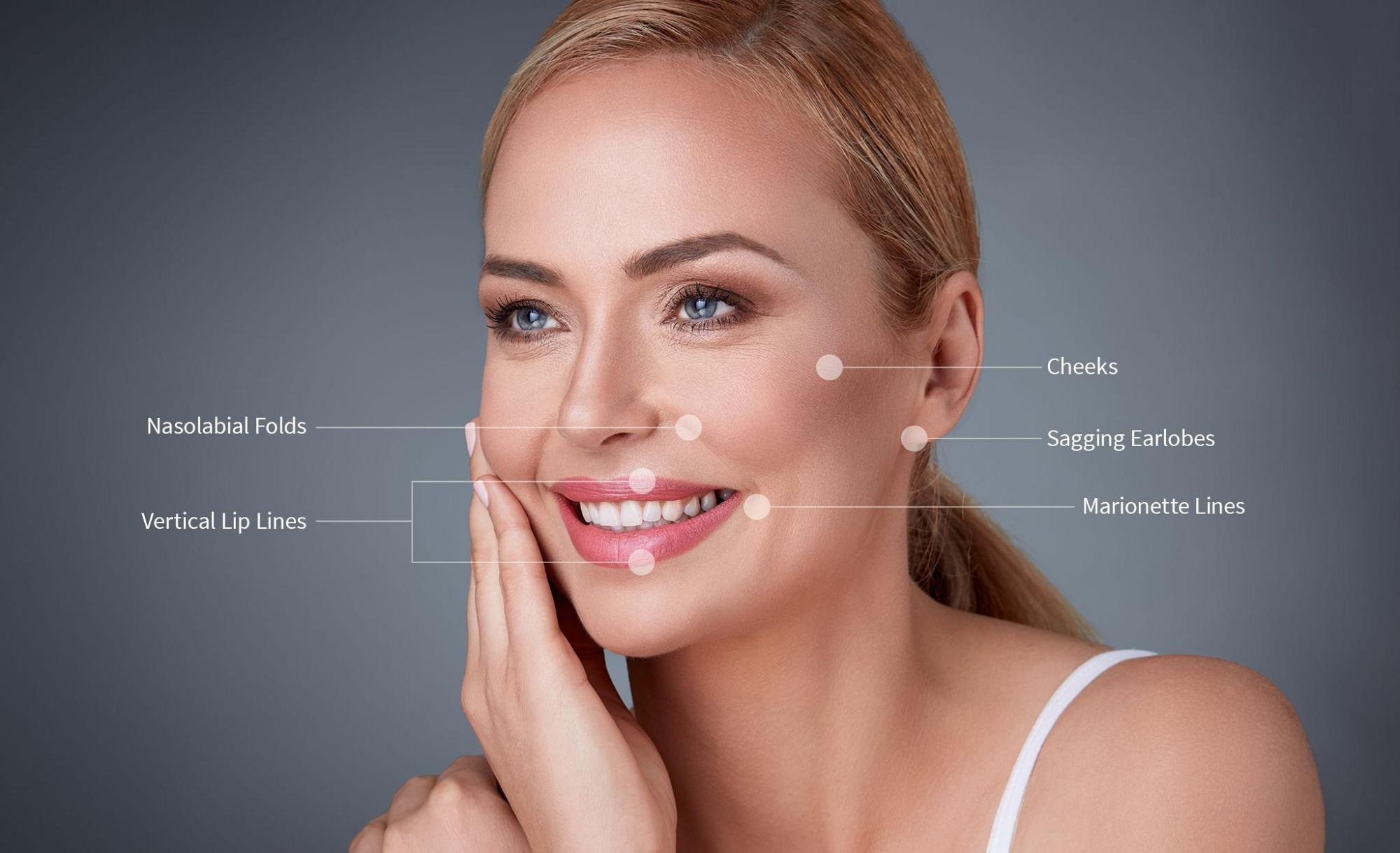 Woman smiling while tags identify where wrinkles occur on the face