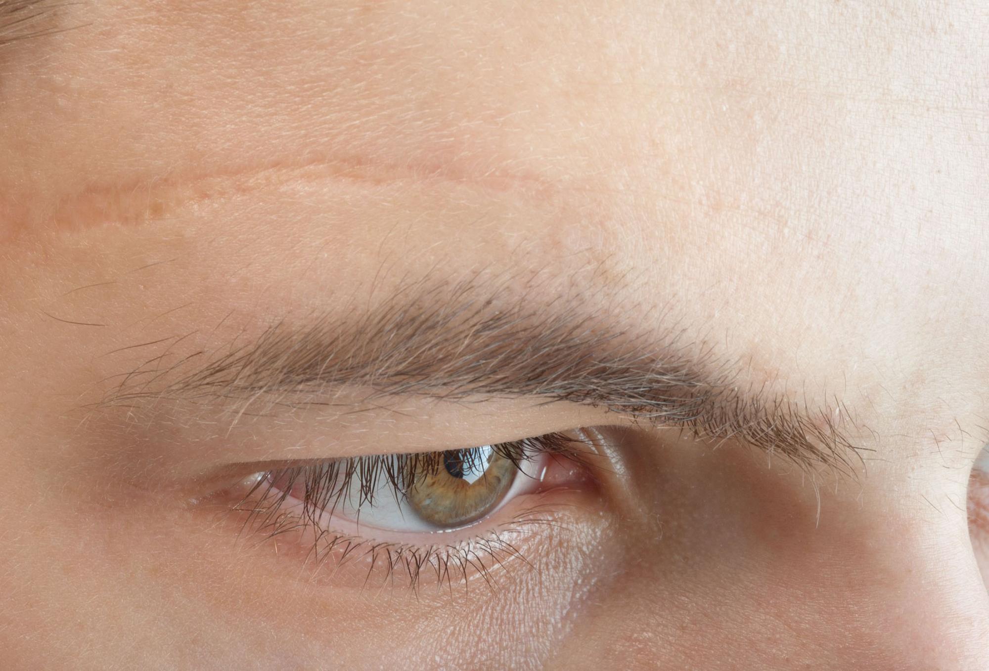 Faded scar