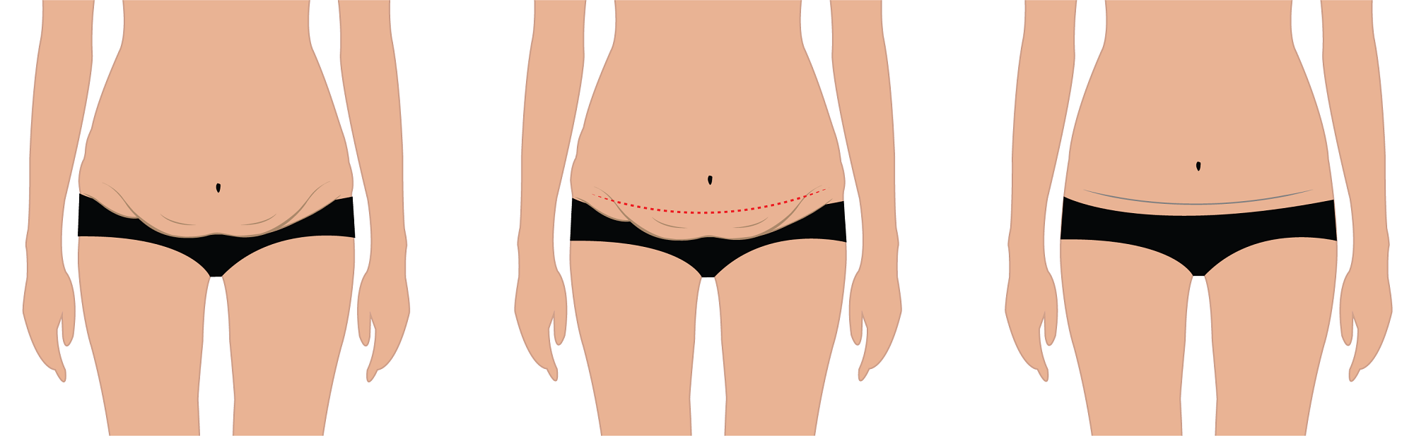 Tummy tuck before and after