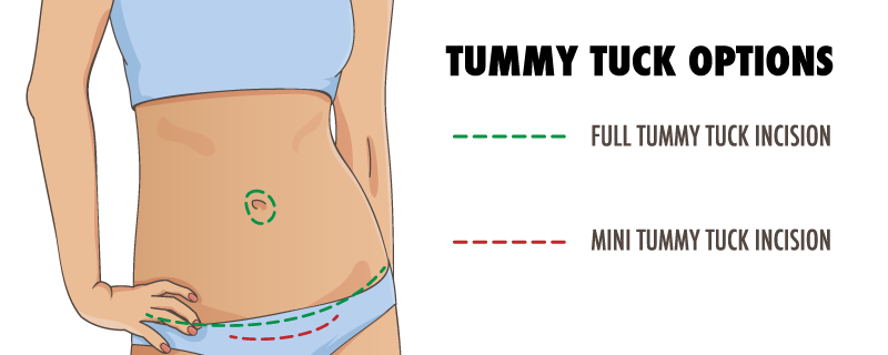 Image shows scar placement for mini and full tummy tuck