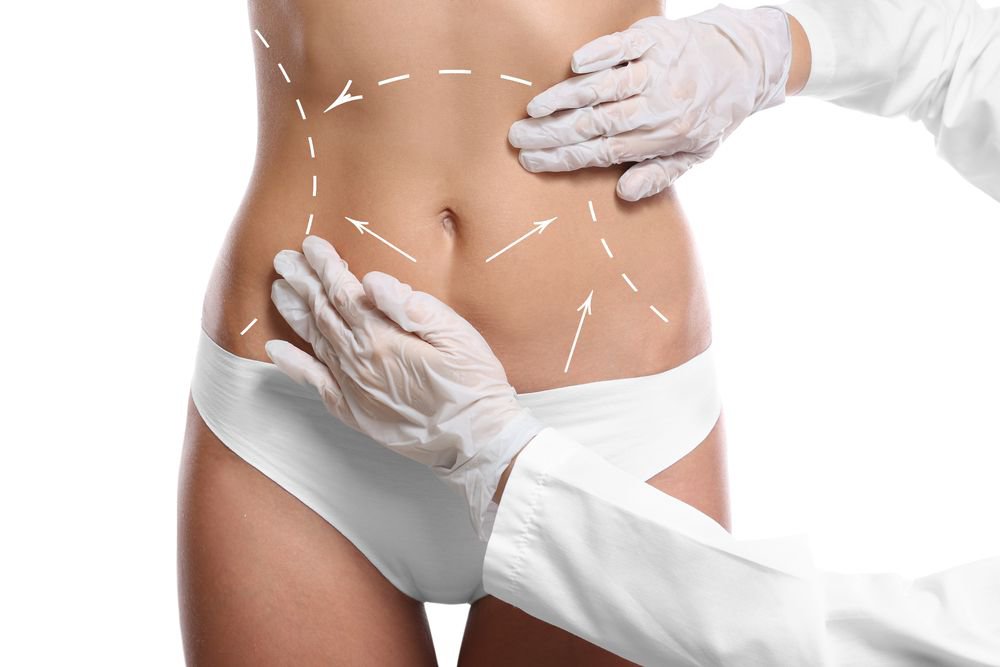 Tummy tuck incision marks