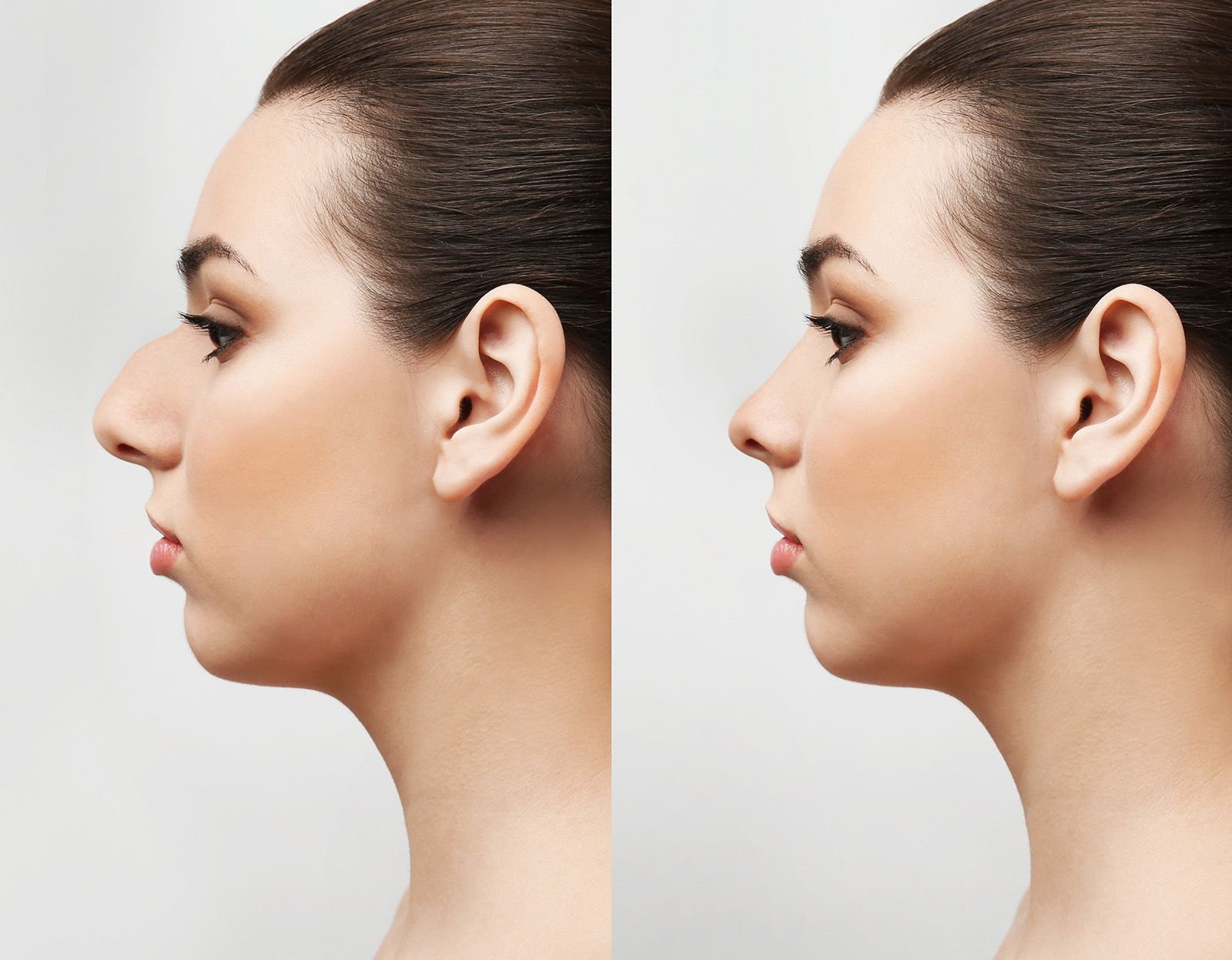 Two photos show before-and-after rhinoplasty shots of female