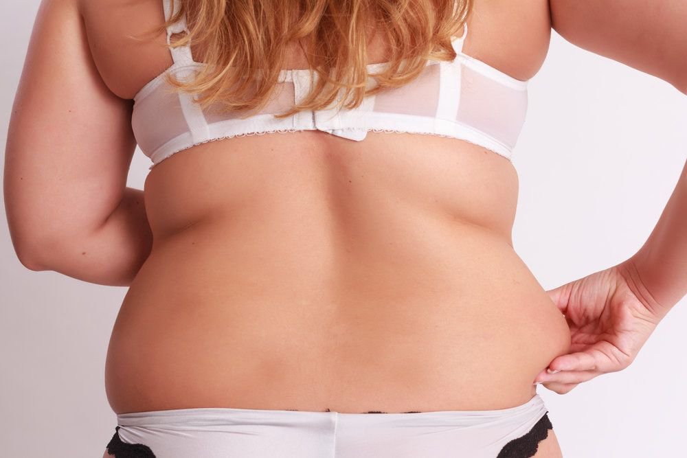 Fairfield County liposuction patient