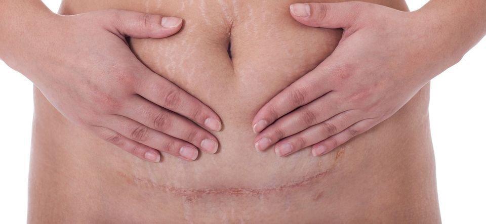 Tummy Tuck Scars Darien, CT & Fairfield County