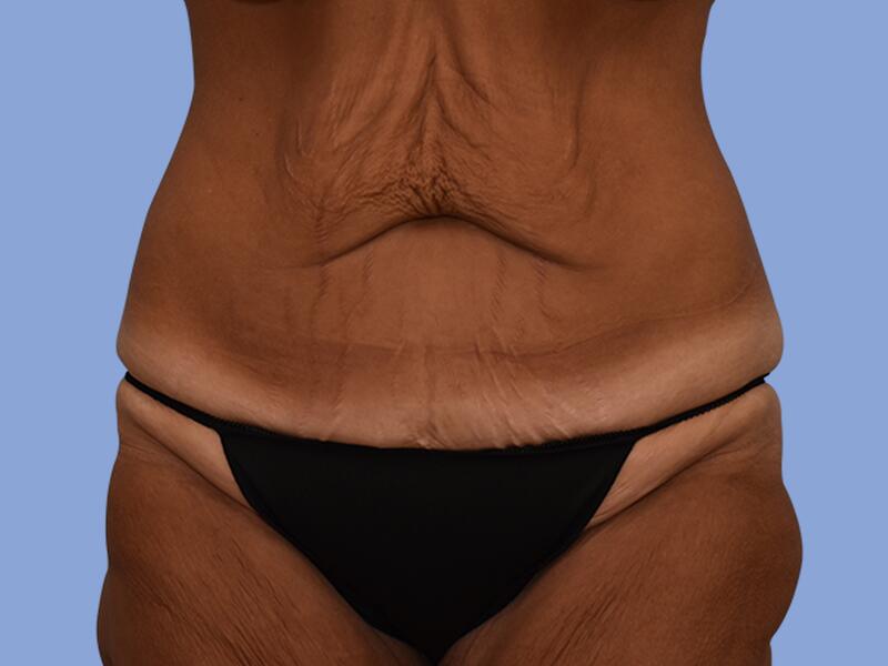 Abdominoplasty before & after photo