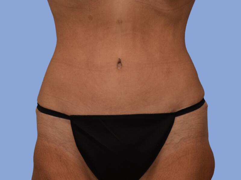 Abdominoplasty before & after photo