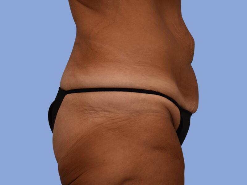 Abdominoplasty before & after photo