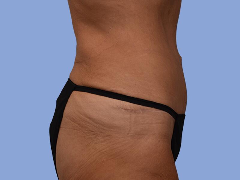 Abdominoplasty before & after photo