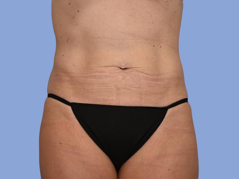 Abdominoplasty before & after photo