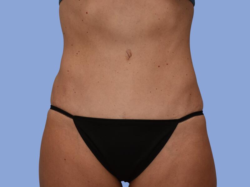 Abdominoplasty before & after photo