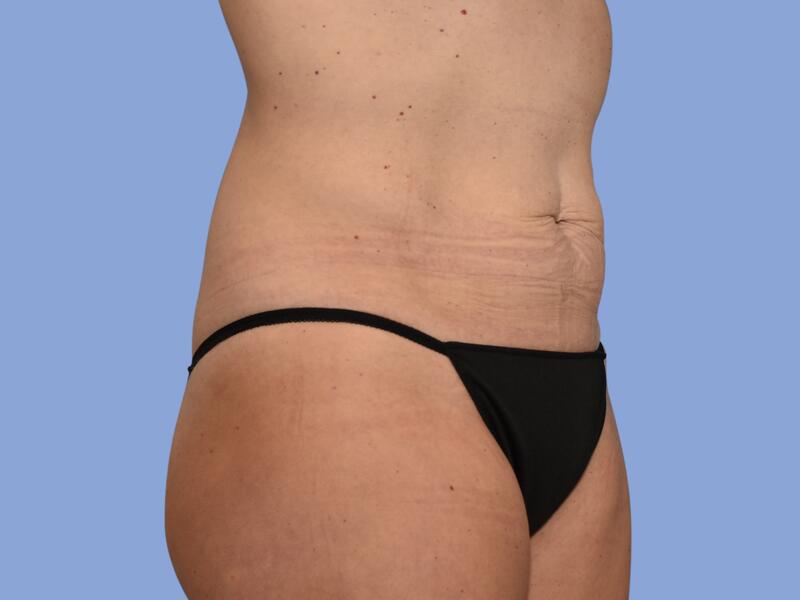 Abdominoplasty before & after photo