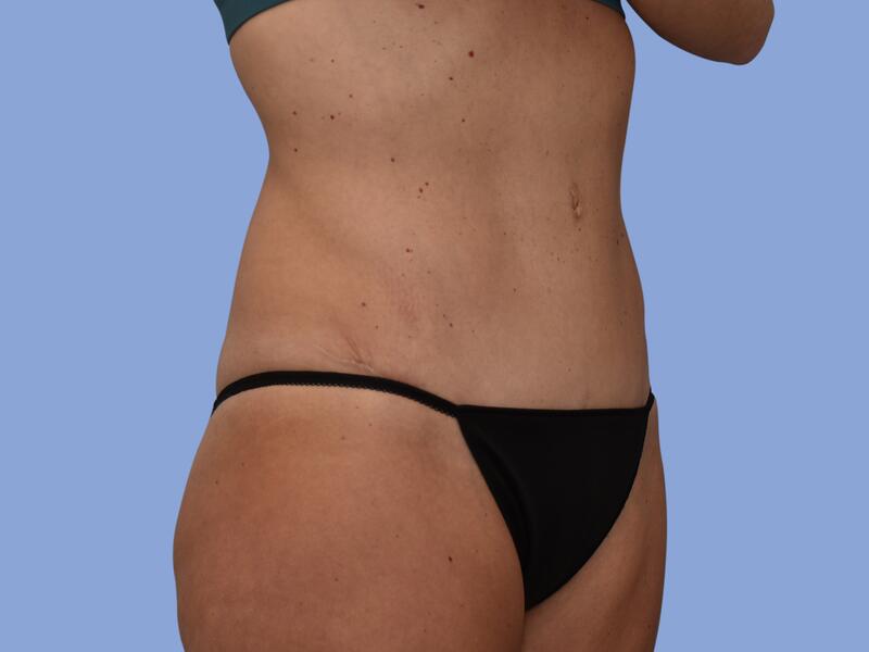 Abdominoplasty before & after photo