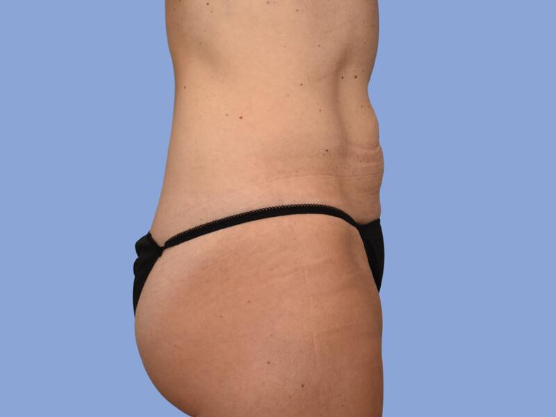 Abdominoplasty before & after photo