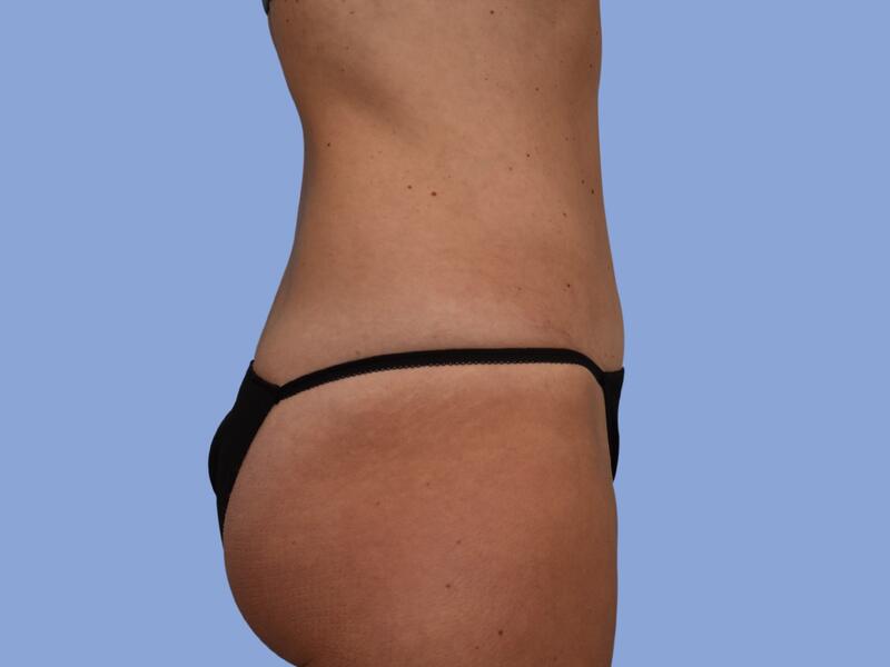 Abdominoplasty before & after photo