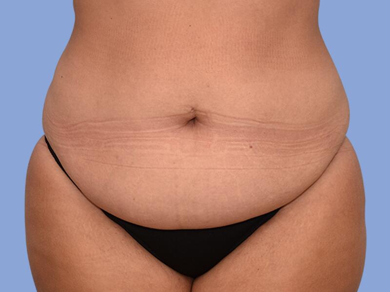 Abdominoplasty before & after photo