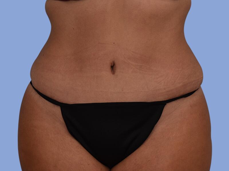 Abdominoplasty before & after photo