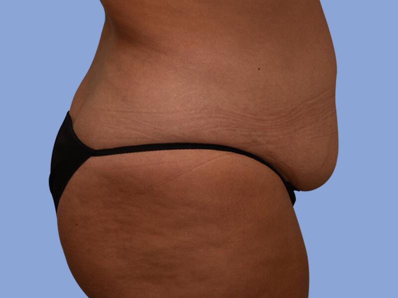 Abdominoplasty before & after photo