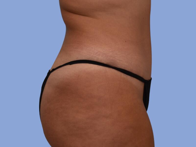 Abdominoplasty before & after photo