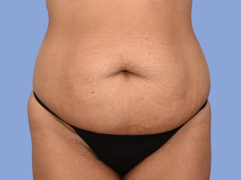 Abdominoplasty before & after photo