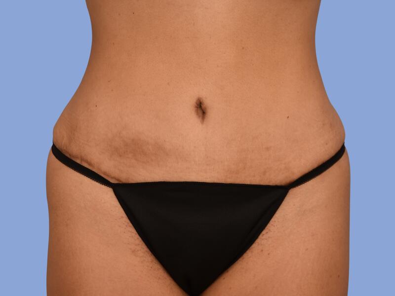 Abdominoplasty before & after photo