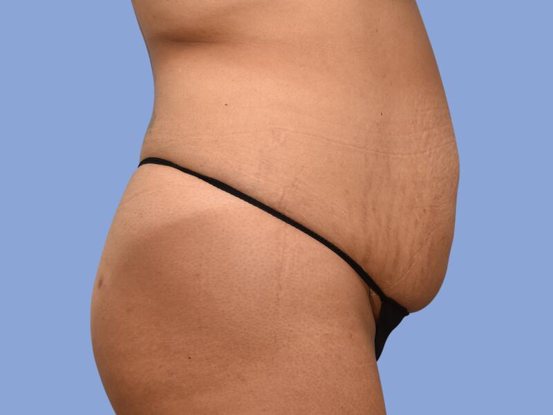 Abdominoplasty before & after photo