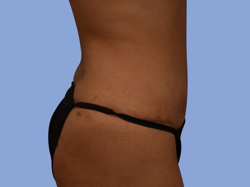 Abdominoplasty before & after photo