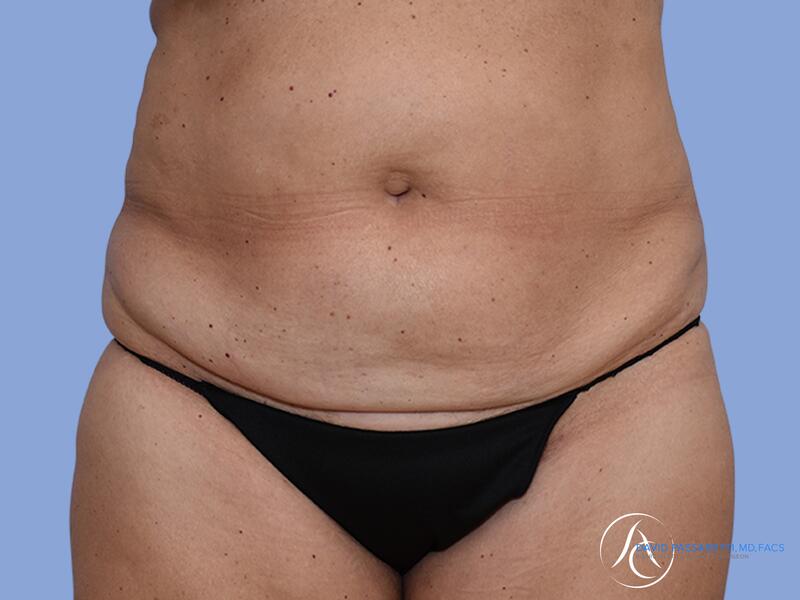 Abdominoplasty before & after photo