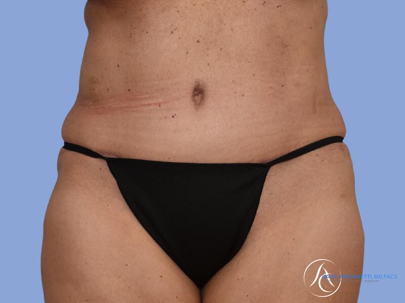 Abdominoplasty before & after photo