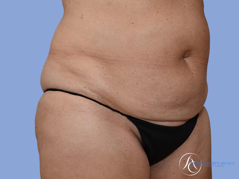 Abdominoplasty before & after photo