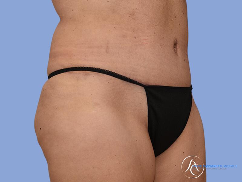 Abdominoplasty before & after photo