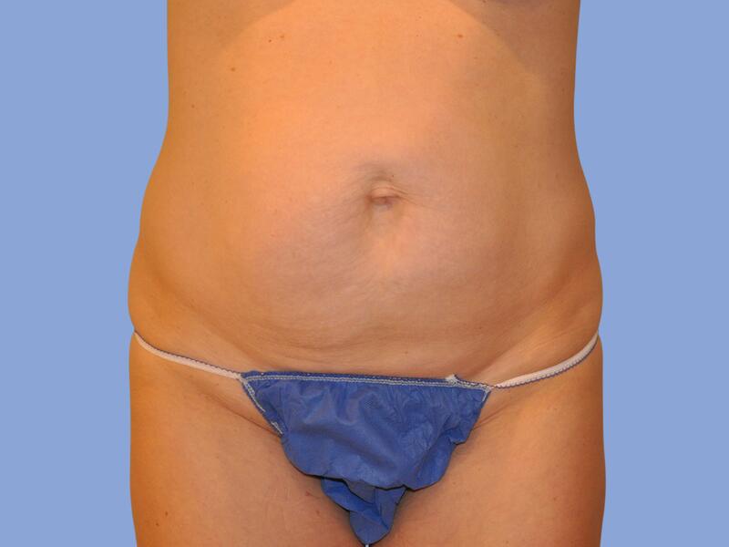 Abdominoplasty before & after photo