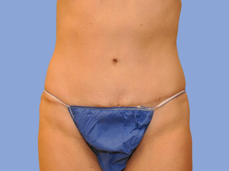 Abdominoplasty before & after photo