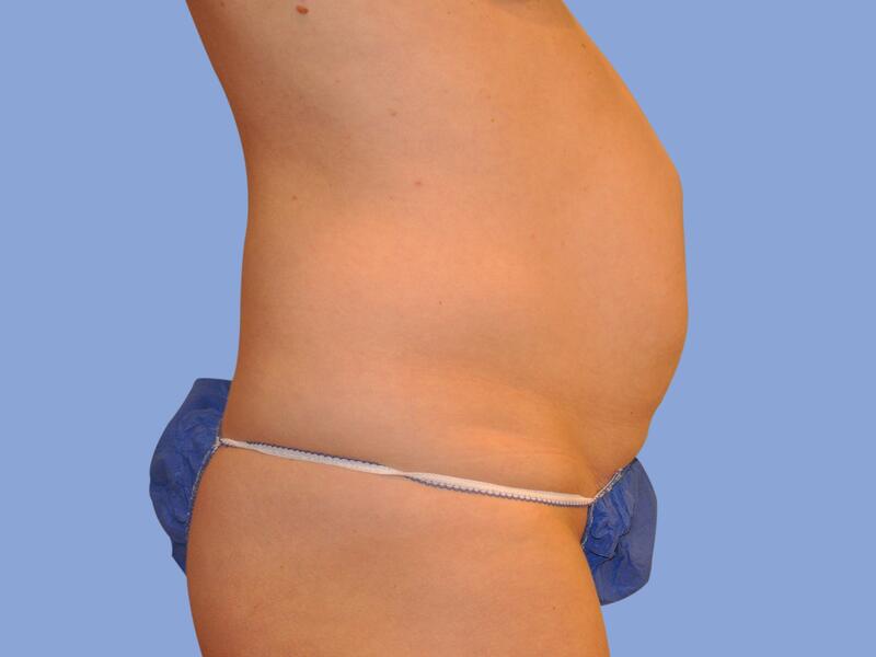 Abdominoplasty before & after photo