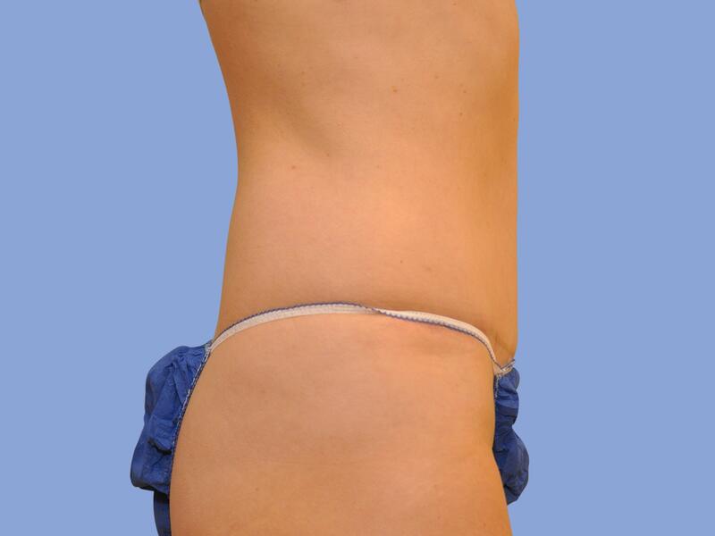 Abdominoplasty before & after photo