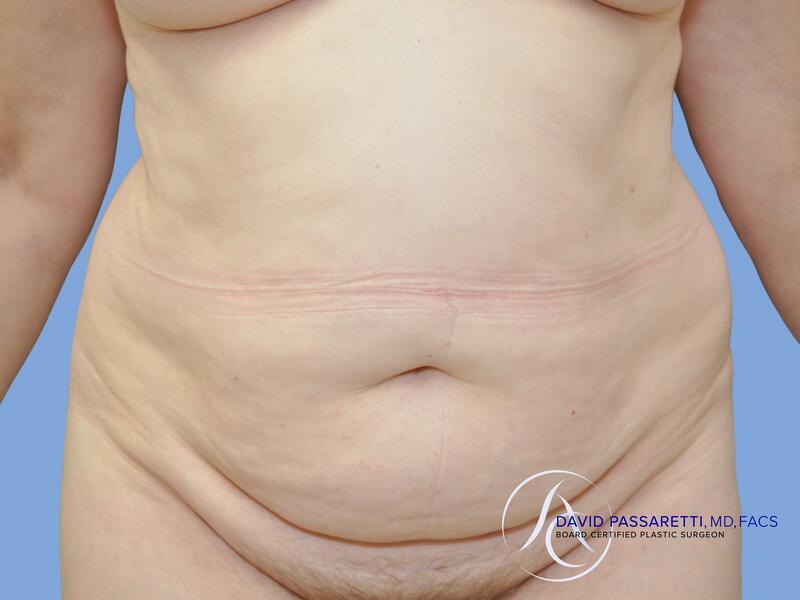 Abdominoplasty before & after photo