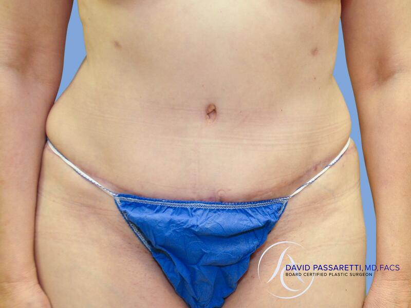 Abdominoplasty before & after photo