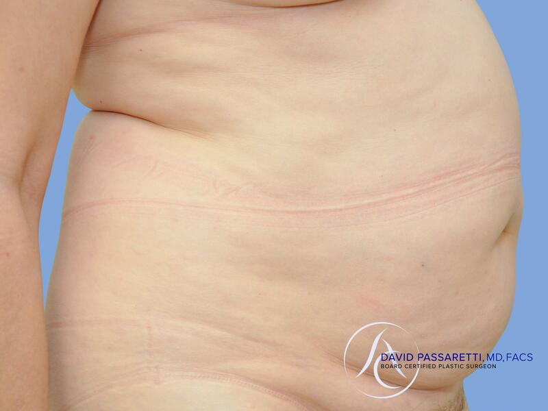 Abdominoplasty before & after photo