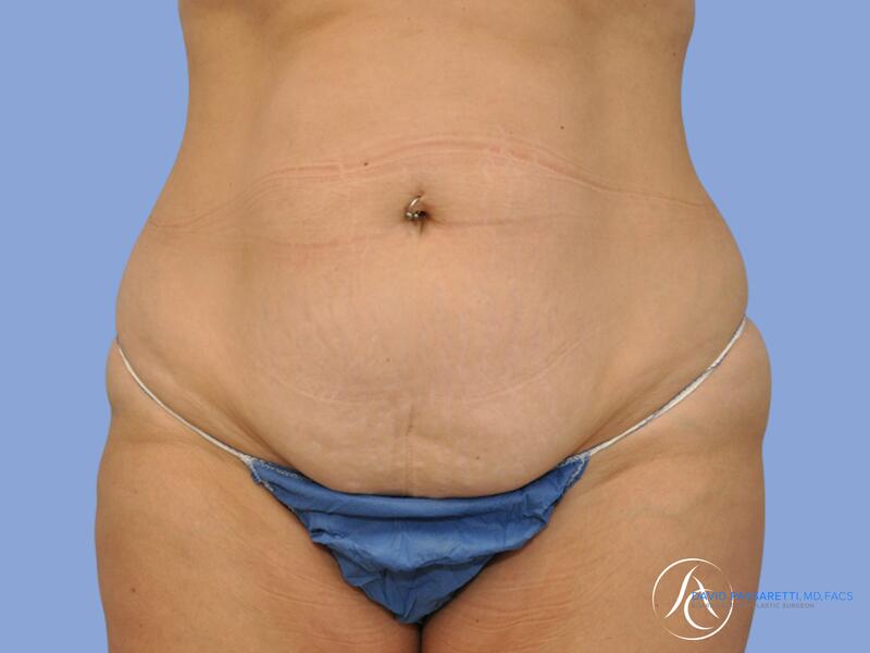 Abdominoplasty before & after photo