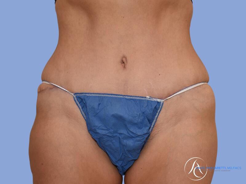 Abdominoplasty before & after photo