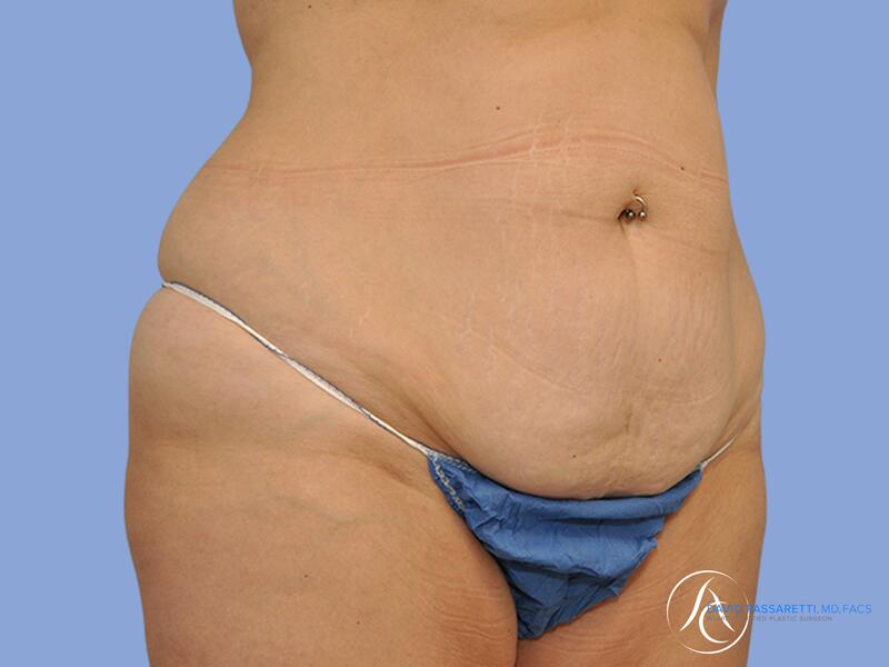 Abdominoplasty before & after photo